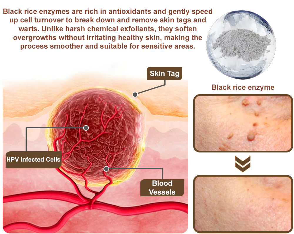 Zvoevo® Rice Bran Essence Cream⚕️ FDA-approved (removes warts and skin tags, improves keratin buildup and skin hyperplasia, follicular keratosis, skin cancer, and age spots)