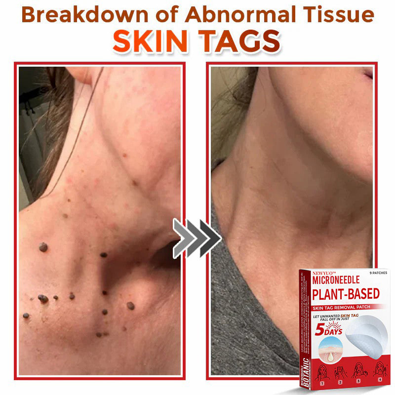 MicroNeedle Plant-based Skin Tag Removal Patch 🇺🇸 Made in the USA