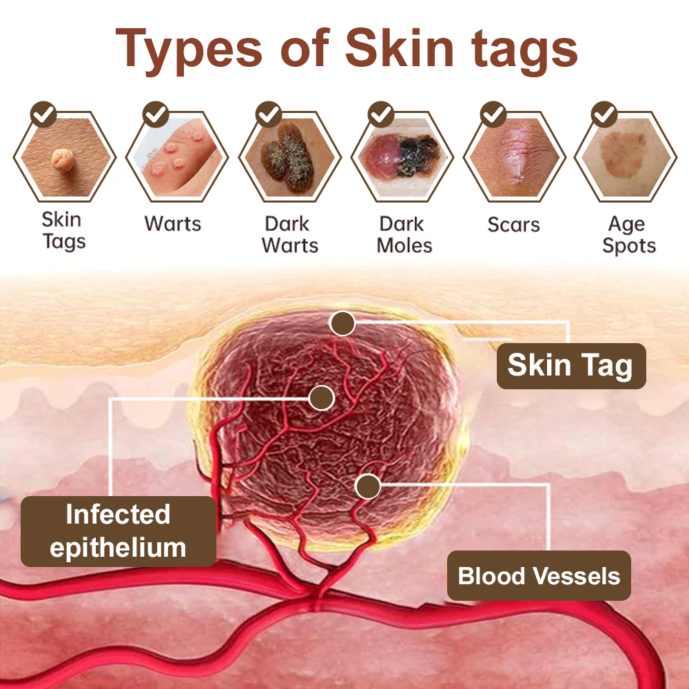 Zvoevo® Rice Bran Essence Cream⚕️ FDA-approved (removes warts and skin tags, improves keratin buildup and skin hyperplasia, follicular keratosis, skin cancer, and age spots)