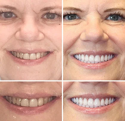 šYUNPSOTM Premium Dentures (Limited Time Offer)š¦·