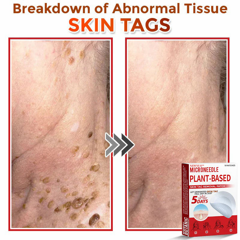 MicroNeedle Plant-based Skin Tag Removal Patch 🇺🇸 Made in the USA