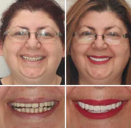 šYUNPSOTM Premium Dentures (Limited Time Offer)š¦·