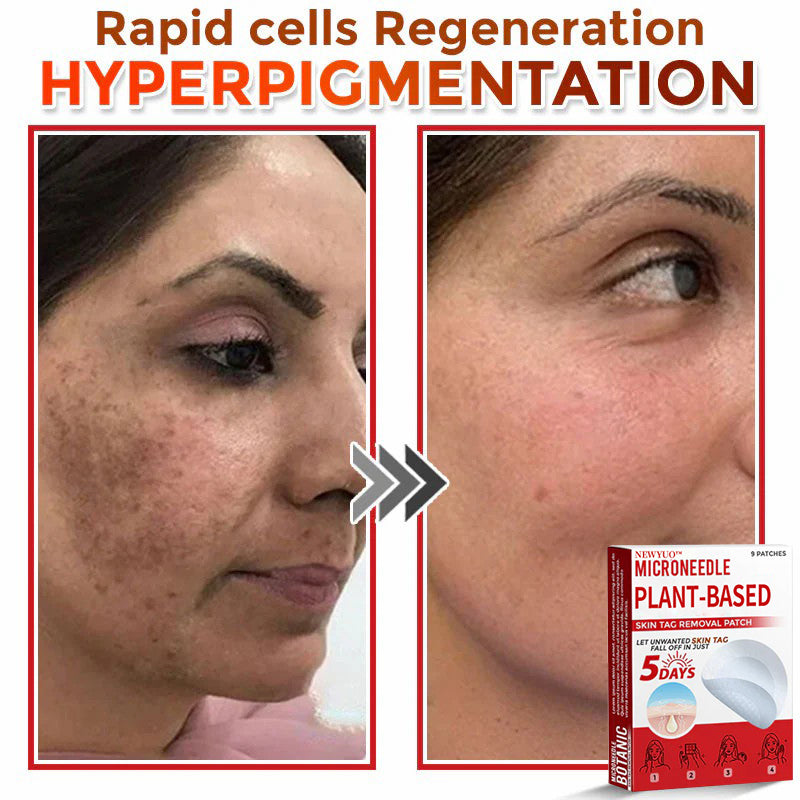 MicroNeedle Plant-based Skin Tag Removal Patch 🇺🇸 Made in the USA