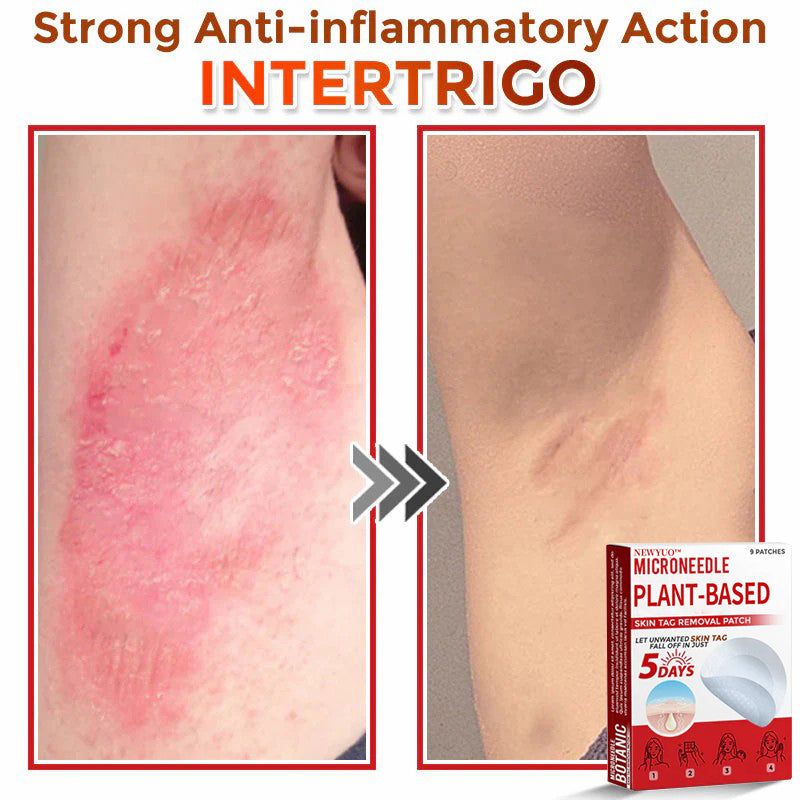 MicroNeedle Plant-based Skin Tag Removal Patch 🇺🇸 Made in the USA