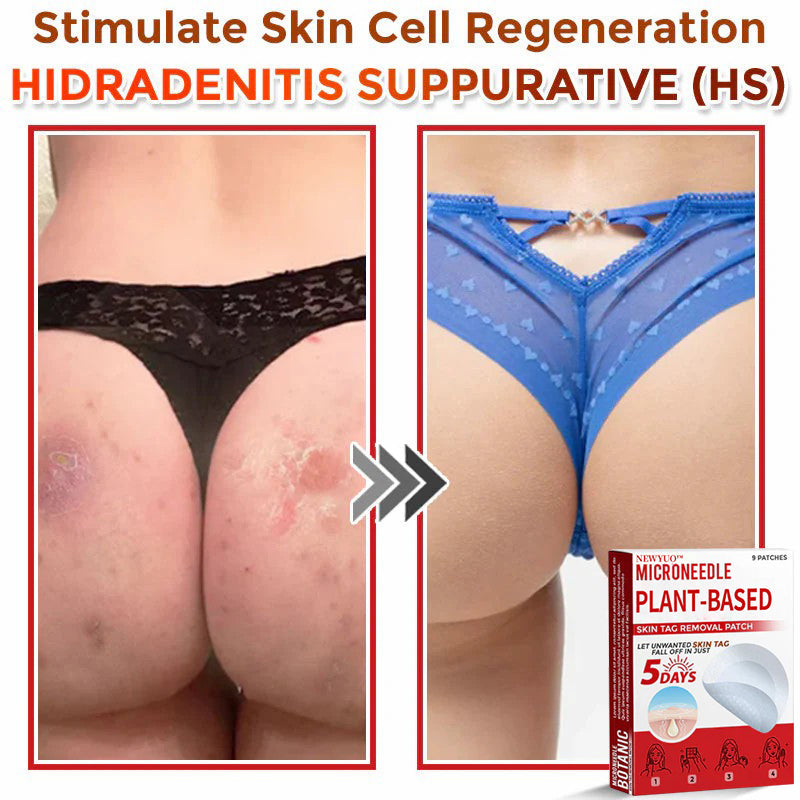 MicroNeedle Plant-based Skin Tag Removal Patch 🇺🇸 Made in the USA