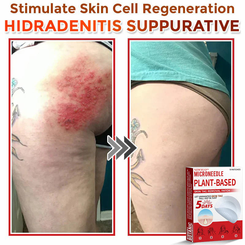 MicroNeedle Plant-based Skin Tag Removal Patch 🇺🇸 Made in the USA