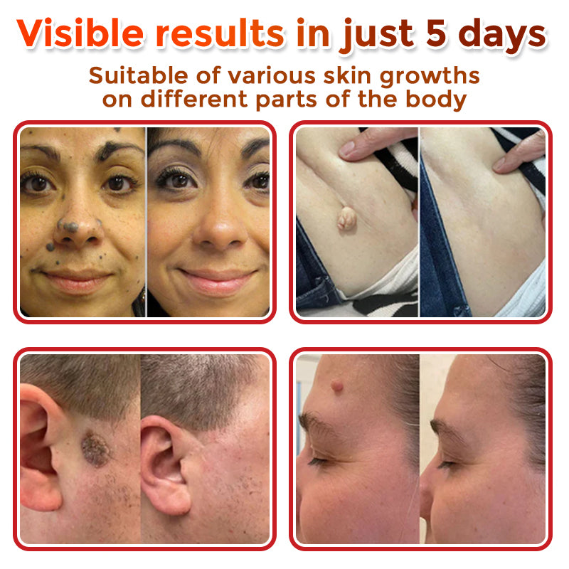 MicroNeedle Plant-based Skin Tag Removal Patch 🇺🇸 Made in the USA