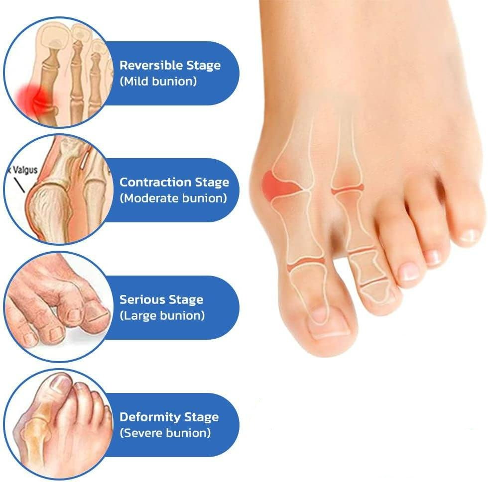 YUNPSOTM Anti - Bunion and Vein Heal Health Socks - Health Sock Bunion Relief Socks Corrector Ortho for Women & Men
