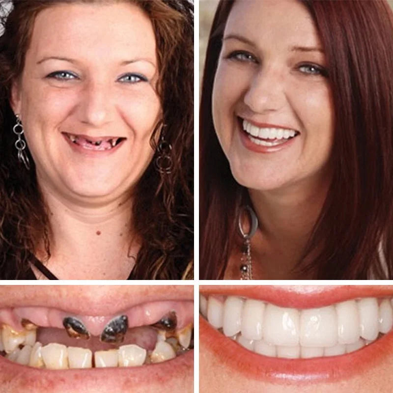 šYUNPSOTM Premium Dentures (Limited Time Offer)š¦·