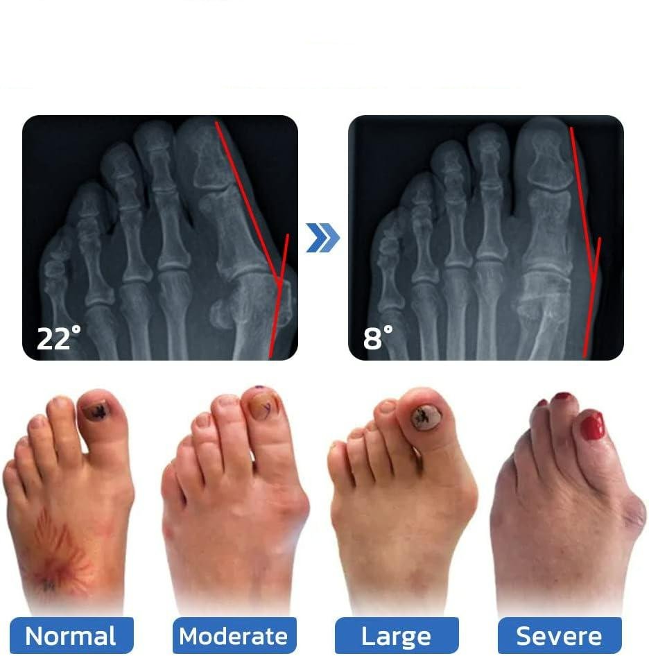 YUNPSOTM Anti - Bunion and Vein Heal Health Socks - Health Sock Bunion Relief Socks Corrector Ortho for Women & Men