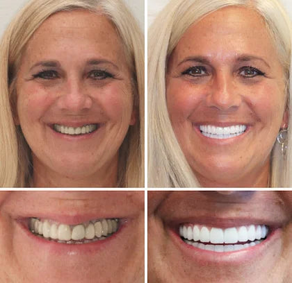 šYUNPSOTM Premium Dentures (Limited Time Offer)š¦·