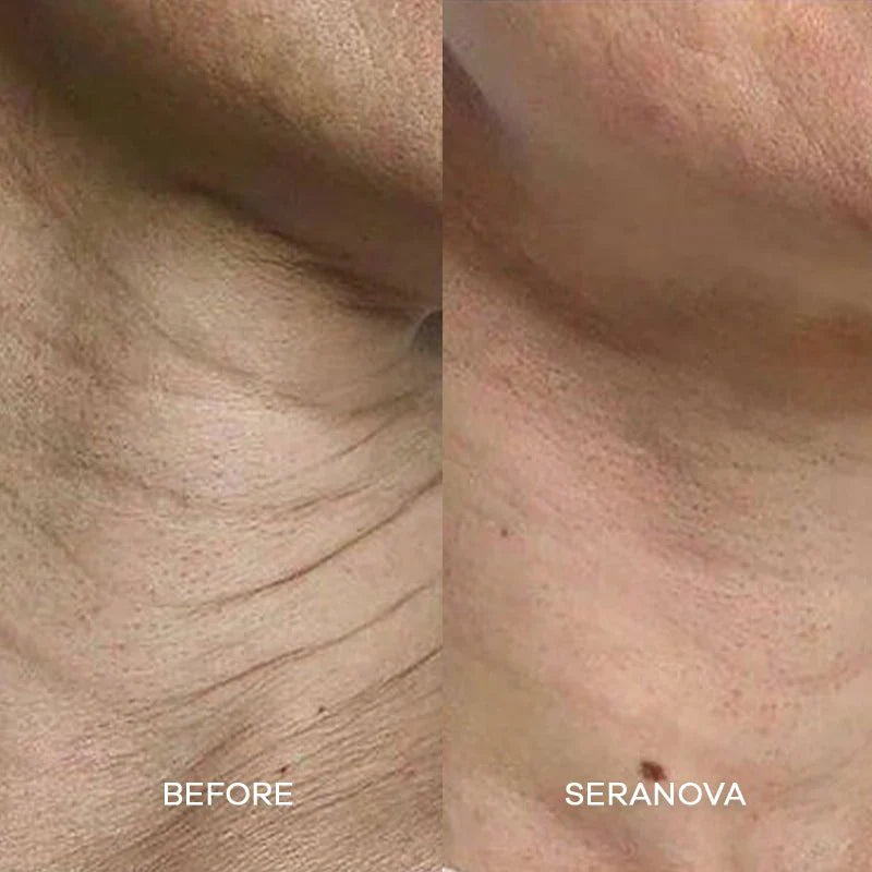 Cougex™ The Micro needling Infusion System